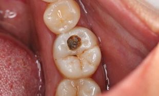 如果长了虫牙怎样挽回,如何挽救长了虫牙的牙齿