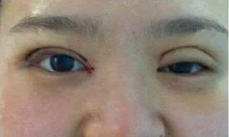 开眼角后悔怎么挽回,开眼角后悔怎么补救