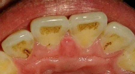 牙齿发黑了怎么挽回,黑色牙齿如何恢复白色？