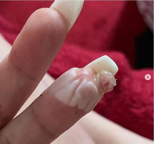 指甲受损怎么挽回老婆呢，怎样才能修复因指甲受损而失去老婆的关系？