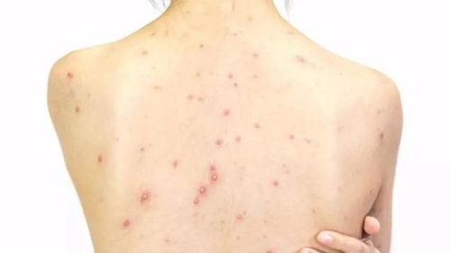 得淋病了怎么挽回,怎样解决得了淋病后的关系问题