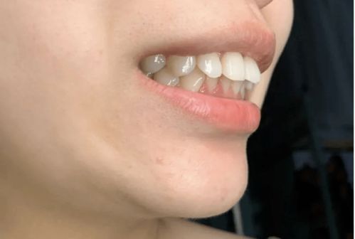 怎么挽回牙套脸,如何解决牙套造成的脸部变形？