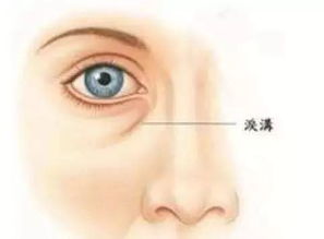 挽回眼睛最快的方法,快速缓解眼疲劳的方法