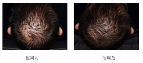 脱发真的可以挽回吗,如何挽回脱发？