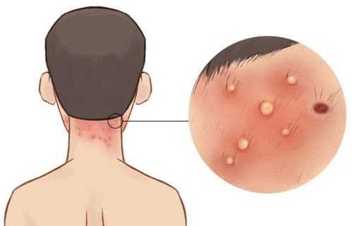 长期刮胡子怎样挽回毛囊，防止秃顶，如何正确刮胡子？