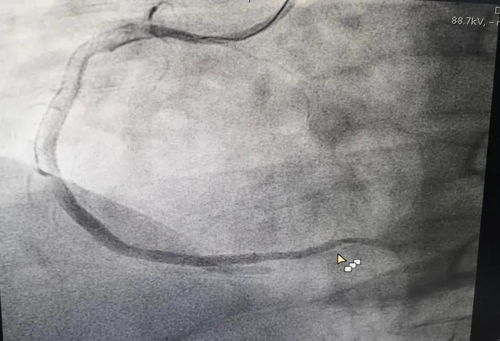 急性心梗怎么挽回,急救心梗，及时挽回！