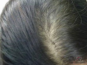 脱发女人怎么挽回颜面,女性脱发如何自救