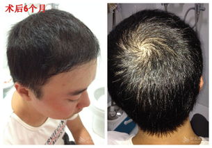 植发挽回发际线，如何解决发际线后移问题？