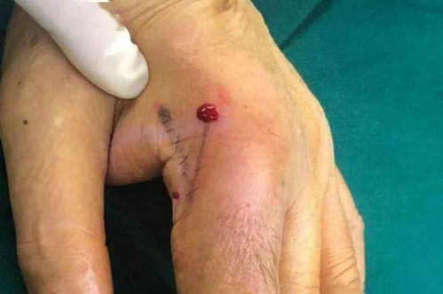 挽回伤口最好的办法,如何最好地治愈伤口