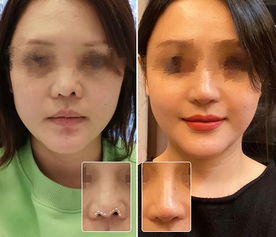 整容失败怎么去挽回,整容失败怎么挽回？新方式解决！