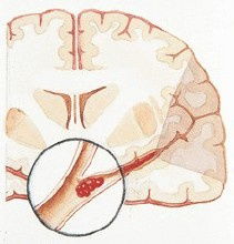 视野缺损可以挽回吗,挽救视野缺损：有救吗？)