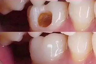 补牙能挽回蛀牙吗，补牙还能补回蛀牙吗？——可否挽救蛀牙的情况