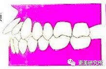 拔牙正畸脸变长怎么挽回，如何避免拔牙正畸导致脸变长，保持完美面部比例？