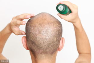 运动性脱发怎么挽回,怎样治疗运动性脱发
