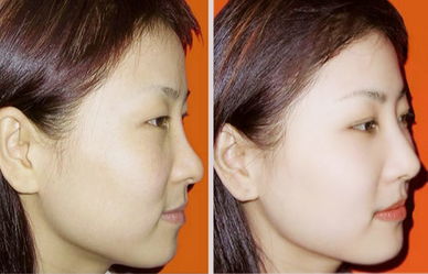 整容后挽回前夫电影，整形美容走上复婚路