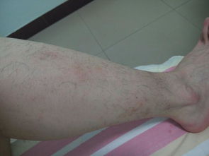 皮肤出血能挽回吗,皮肤出血是否能治愈？