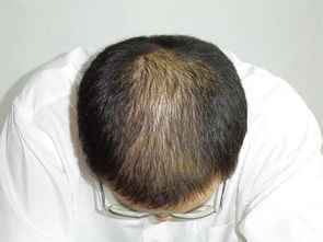 脱发以后很难挽回吗,脱发难以逆转？如何防止脱发
