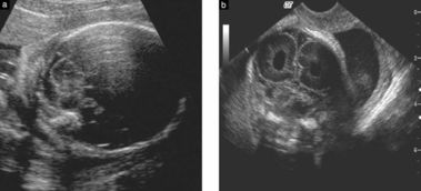 胎儿小脑偏小怎么挽回,胎儿小脑偏小如何补救