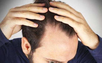 秃头无可挽回,脱发不可逆，在线解决方案