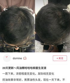 如何挽回发际线后退,改善发际线，让头发更浓密