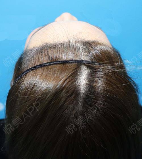 头发受损怎样可以挽回,如何修复受损头发