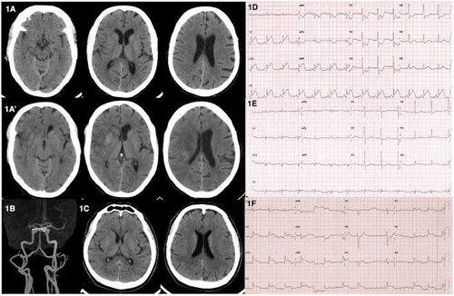 血管堵了怎么挽回,血管堵塞如何拯救？