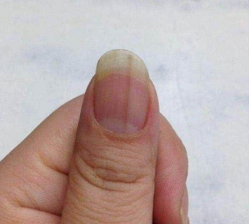 指甲受损可以挽回吗,如何挽救受损指甲
