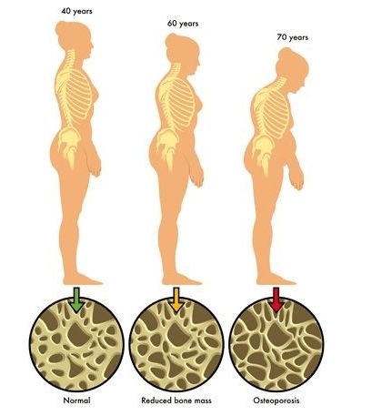 骨相衰老可以挽回吗,能通过骨密度检测预测骨相衰老的发展吗？