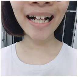 整容可以挽回前任吗,整容能否让前任复合？