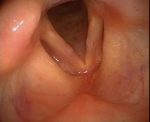 声音较粗如何挽回,如何挽回喉咙疲劳？
