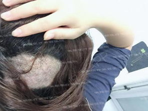 发际线怎么挽回,重获发际线：如何挽救头发稀疏？