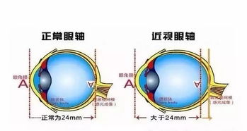 近视无法挽回吗,近视是否能得到矫正