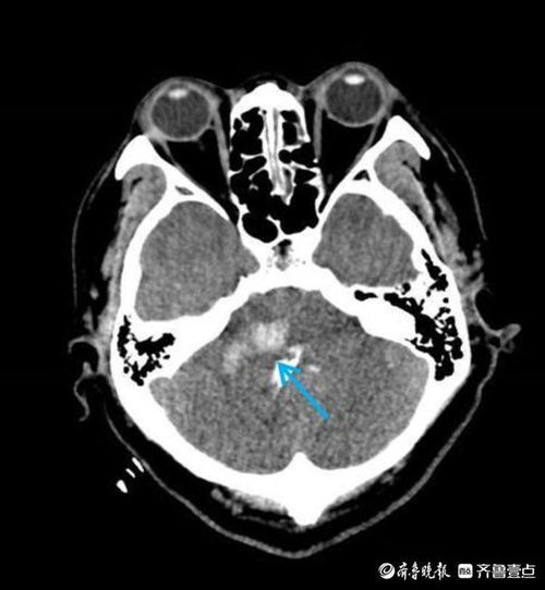 脑瘤男逆袭挽回,瘤男逆袭：成功挽回生命