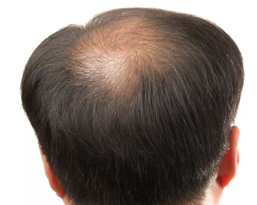脱发以后很难挽回吗,脱发难以逆转？如何防止脱发