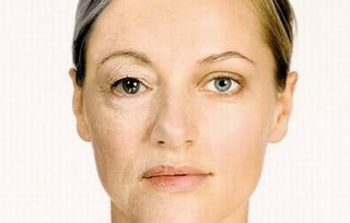 苹果肌下垂怎么挽回,重振苹果肌！解决下垂问题