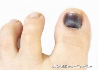 指甲受损可以挽回吗,如何挽救受损指甲