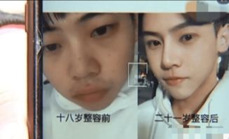 整容后挽回前男友,整容成功！成功挽回前男友！