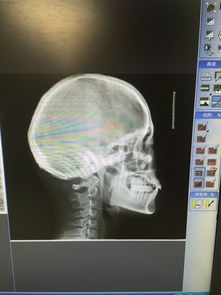 拔牙正畸脸变长怎么挽回，如何避免拔牙正畸导致脸变长，保持完美面部比例？