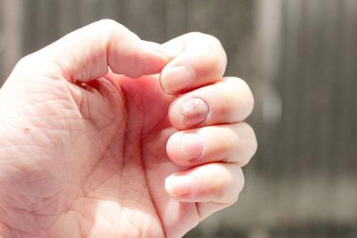 指甲变形还能挽回吗，如何拯救变形的指甲？