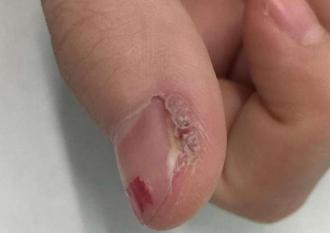 指甲变形还能挽回吗，如何拯救变形的指甲？